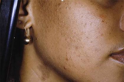 natural remedies for your dark spots
