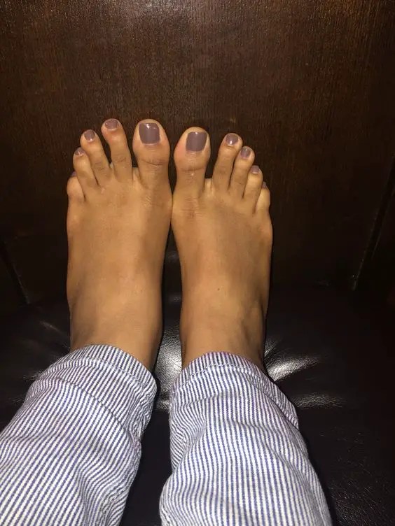 A picture of an ugly toe nail