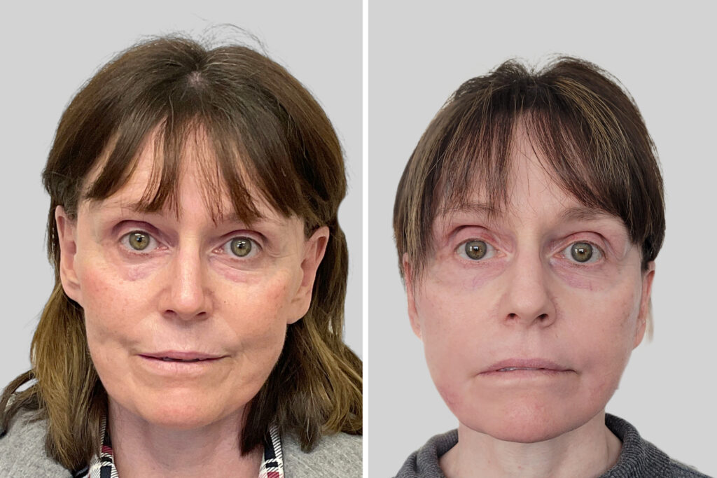 Phenol Peel All You Need to Know About this Deep Chemical Peel