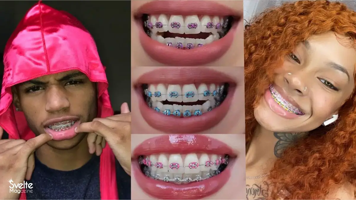 How to Pick the Best Braces Colors for Your Teeth